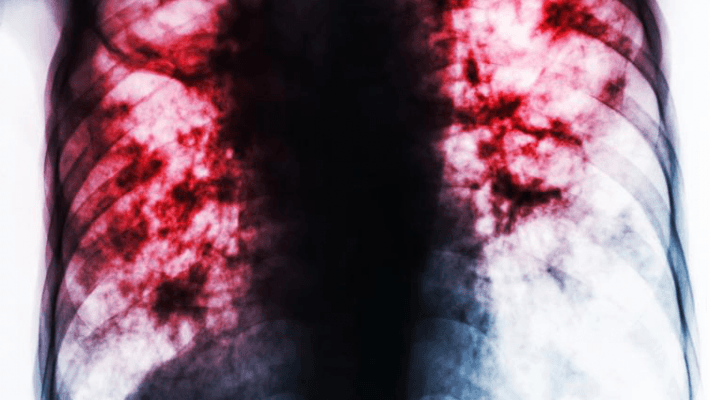 Fibrosis-Related Diseases The Potential of Using Halofuginone to Treat Fibrosis-Related Diseases